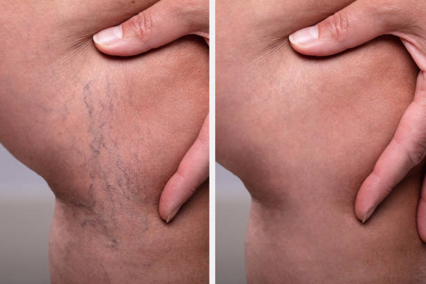 istock Treatment Of Varicose Before And After 1155812275