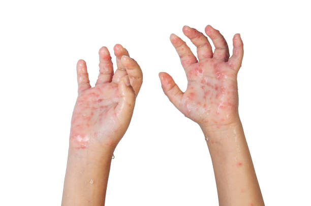 istock Chickenpox varicella zoster virus 1155829442