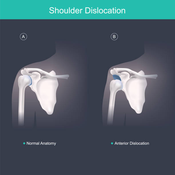 ilustraciones, imágenes clip art, dibujos animados e iconos de stock de esto es uso para explicar y comparar cuando la cabeza del húmero está fuera de la articulación del hombro incluyen dolor en el hombro. cuerpo anatomía ilustración humana. - shoulder bone