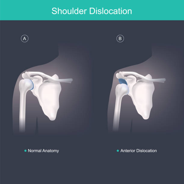 This is use for explain and compare when the head of the humerus is out of the shoulder joint include shoulder pain. Anatomy body human illustration. vector art illustration
