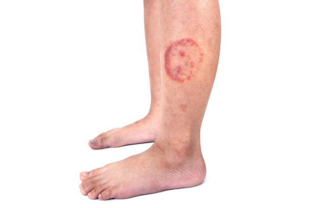 Ringworm infection or Tinea corporis on skin isolated on white background,  Dermatophytosis on skin isolated Ringworm infection or Tinea corporis on skin isolated on white background,  Dermatophytosis on skin isolated ringworm photos stock pictures, royalty-free photos & images