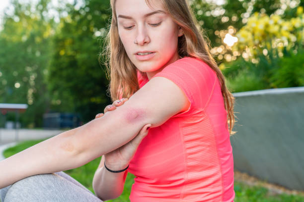 A young woman has an insect bite which is reddened A young woman has an insect bite which is reddened bug bite photos stock pictures, royalty-free photos & images