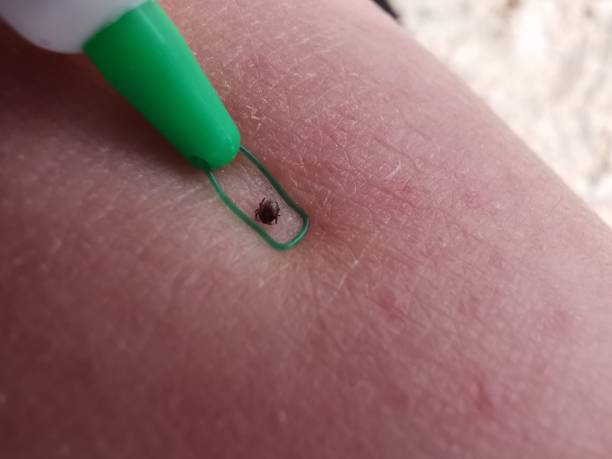 Tick being removed from woman's skin after biting in Mobile shot clew bay stock pictures, royalty-free photos & images