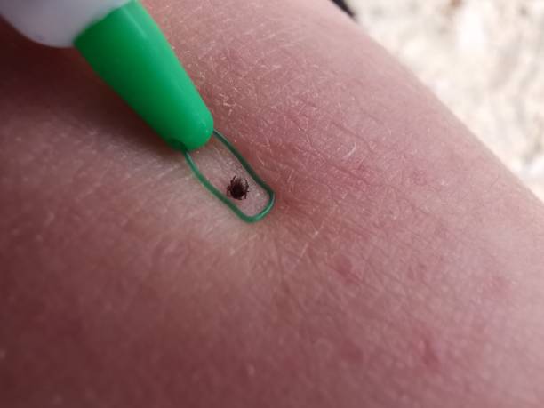 tick being removed from woman's skin after biting in - clew bay imagens e fotografias de stock
