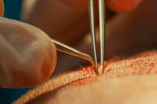 Macrophotography of a hair bulb transplanted into a hairless area. Baldness treatment. Hair transplant. Surgeons in the operating room carry out hair transplant surgery. Surgical technique that moves hair follicles from a part of the head