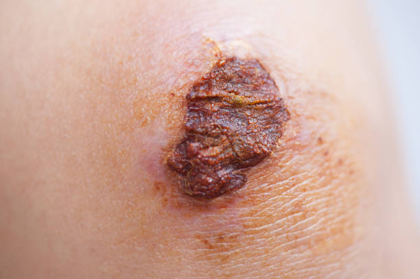Scar and scab (eschar) on asian female knee Scar and scab (eschar) on asian female knee eschar stock pictures, royalty-free photos & images