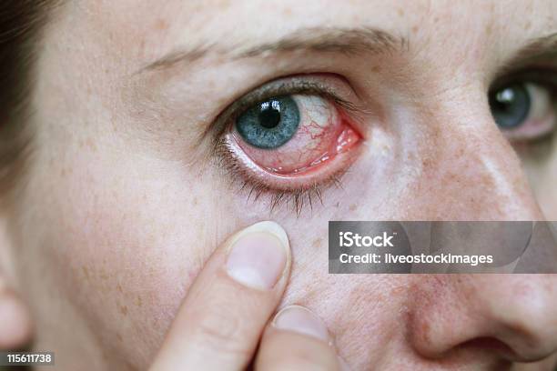 Red Eye Nach Menschen Attack Stockfoto und mehr Bilder von Auge - Auge, Geschwollen, Entzündung