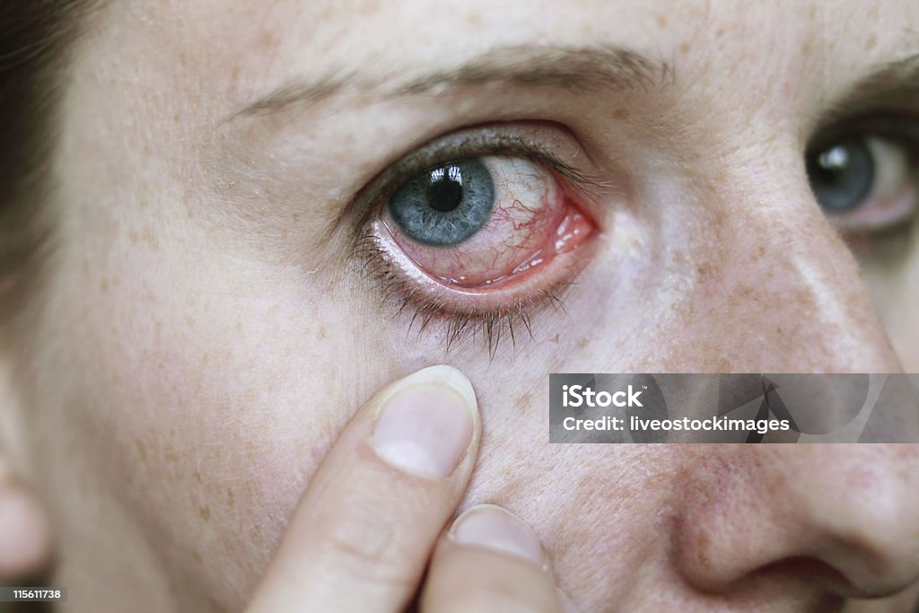 Rosso occhio dopo hayfever attacco - Foto stock royalty-free di Occhio