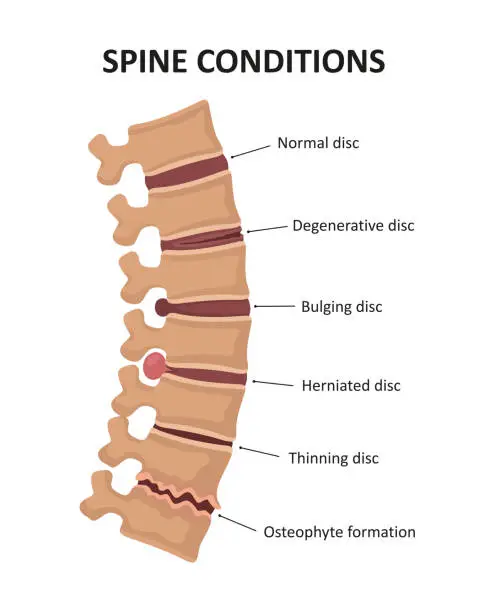 Vector illustration of Stages of spinal osteochondrosis. Degenerative Disc. Bulging Disc. Herniated Disc. Thinning Disc