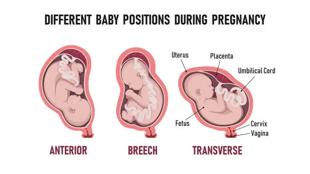 Vector illustration of Different baby positions during pregnancy