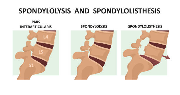 ilustrações, clipart, desenhos animados e ícones de espondilólise e espondilolistese - human spine human vertebra disk spinal