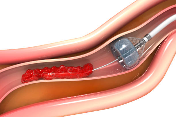 angioplastie de stent - angioplasty photos et images de collection