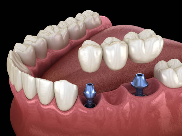 istock Dental bridge supported by implants. Medically accurate 3D illustration of human teeth and dentures concept 1156477581
