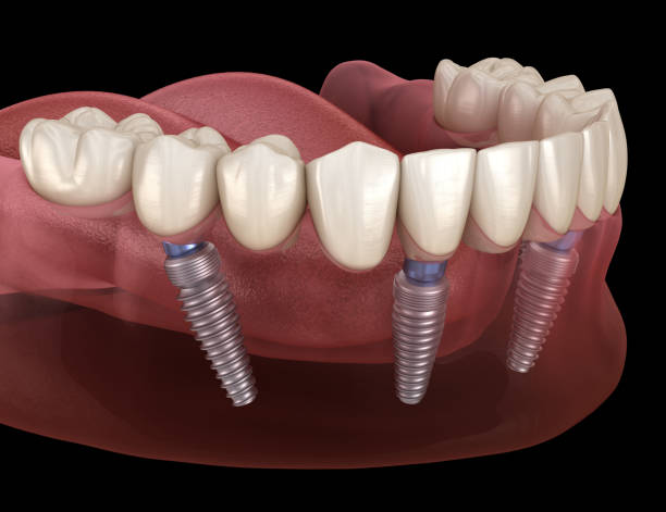 mandibular prosthesis all on 4 system supported by implants. medically accurate 3d illustration of human teeth and dentures concept - implantat imagens e fotografias de stock