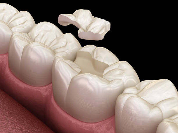 istock Inlay ceramic crown fixation over tooth. Medically accurate 3D illustration of human teeth treatment 1156477642