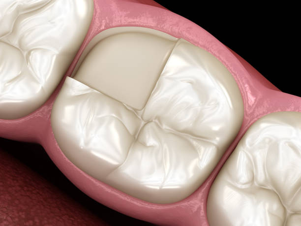 istock Onlay ceramic crown fixation over tooth. Medically accurate 3D illustration of human teeth treatment 1156477644