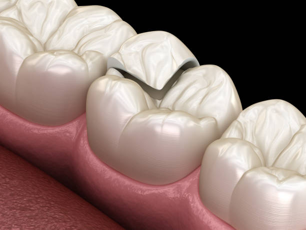 istock Onlay ceramic crown fixation over tooth. Medically accurate 3D illustration of human teeth treatment 1156477648