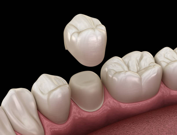 istock Preparated premolar tooth for dental crown placement. Medically accurate 3D illustration 1156477696