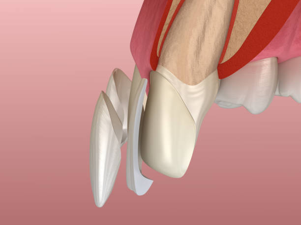 istock Veneer installation procedure over central incisor and lateral incisor. Sliced view, 3D illustration 1156477700