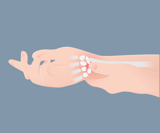 Wrist Bones Injury Stock Illustration - Download Image Now - Carpal Tunnel  Syndrome, Rheumatoid Arthritis, Wrist - iStock