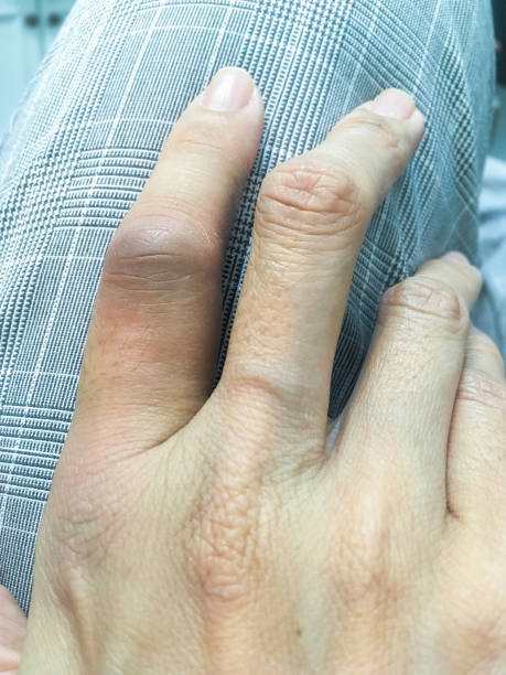 The female finger was swollen stock photo
