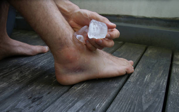 cooling a swollen injured ankle with ice - sprain imagens e fotografias de stock
