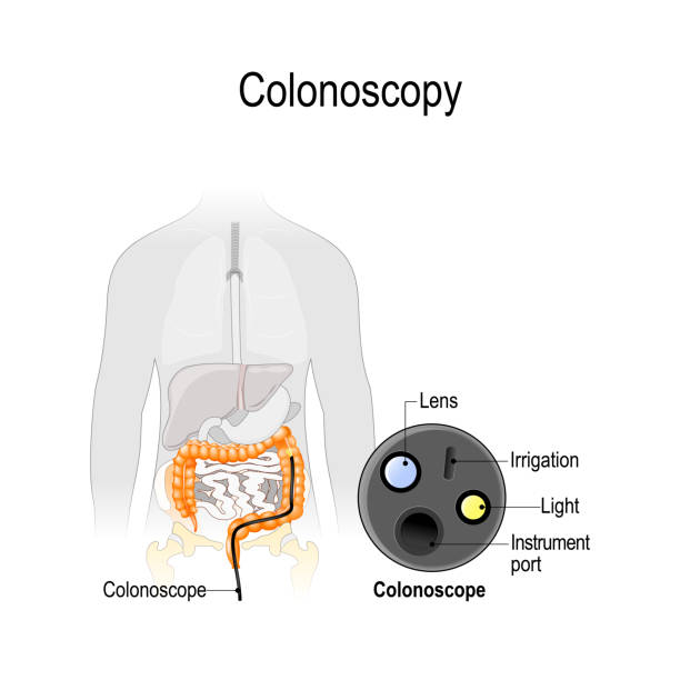 colonoscopy in the colon. Silhouette of the man with the colon and close-up of endoscope. colonoscopy in the colon. Silhouette of the man with the colon and endoscope. close-up instruments of a colonoscope. Vector illustration for biological, medical and science use colon cancer screening stock illustrations