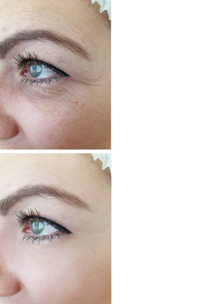 istock woman face wrinkles before and after correction 1156918309
