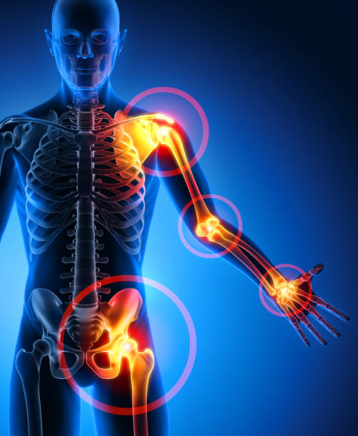 istock Pain in all joints-conceptual artwork-3d Illustration 1156927072