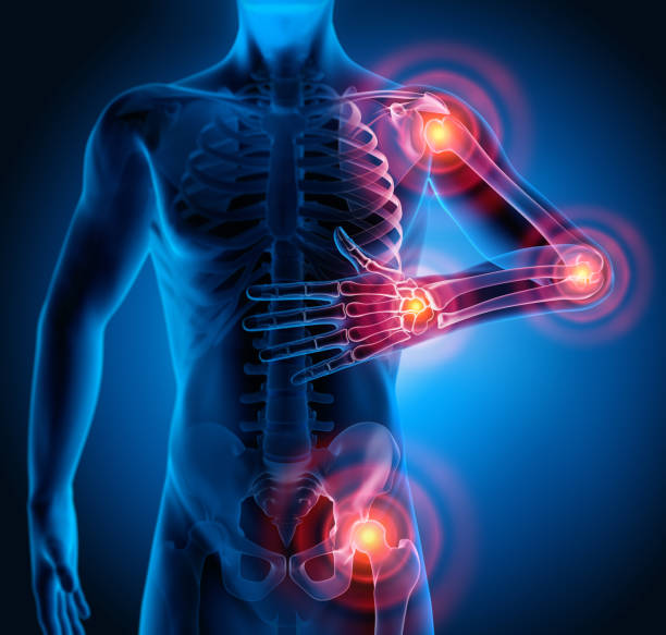 istock Pain in all joints-conceptual artwork-3d Illustration 1156927812