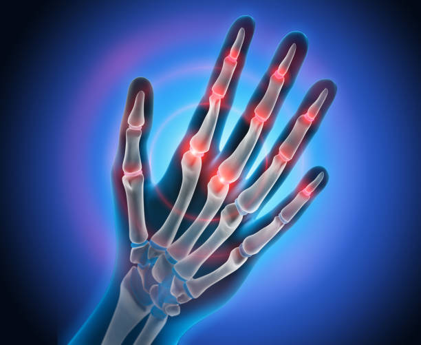 Handskelett - conceptual artwork - 3d Illustration Pain in the finger joints - Medical Illustration - 3D Rendering rheumatoid arthritis stock pictures, royalty-free photos & images