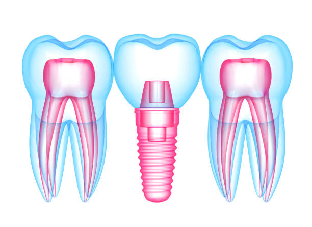 istock 3d render of teeth with dental implant over white 1157071005