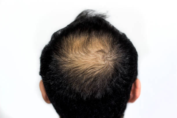 istock male lost his top hair, getting bald 1157215755