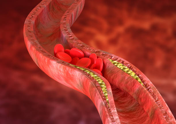 l'aterosclerosi è un accumulo di placche di colesterolo nelle pareti delle arterie, che causa ostruzione del flusso sanguigno. rendering 3d - cholesterol foto e immagini stock