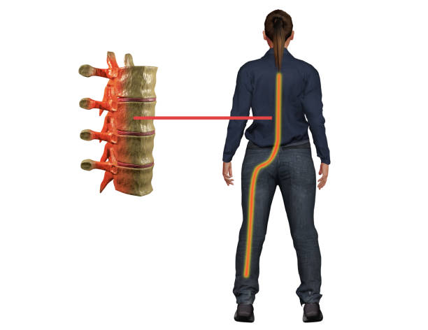 la douleur de sciatica, un symptôme de perturbation dans le nerf de la colonne vertébrale, atteint la jambe et cause l'inconfort. illustration 3d - dégénératif photos et images de collection