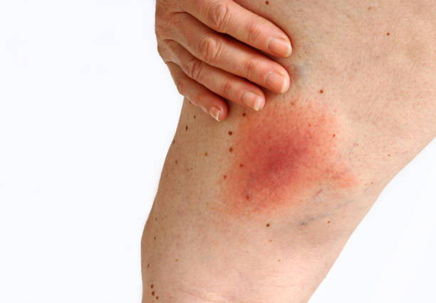 Wandering flush Lyme borreliosis of the leg of a woman transmitted by a tick Wandering flush Lyme borreliosis of the leg of a woman transmitted by a tick. Lyme disease caused by a tick bite on the thigh. beesting cake stock pictures, royalty-free photos & images