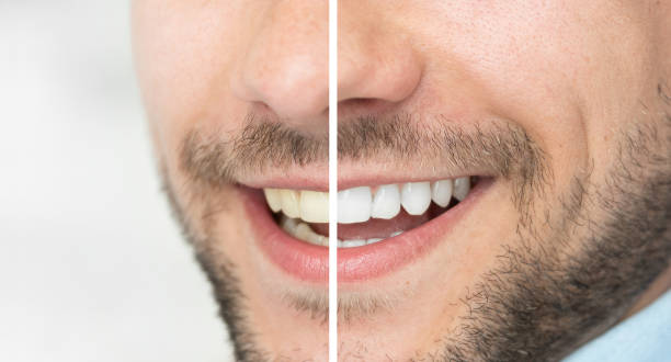 Dental care and whitening teeth compare Dental care and whitening teeth. Compare smile before and after bleaching. tooth whitening photos stock pictures, royalty-free photos & images