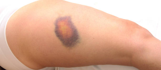 Woman, big blue bruise on the thigh stock photo