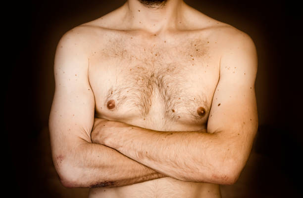 istock Moles on the chest of a man. 1157430427