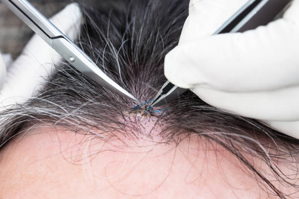 istock Closeup, doctor removing stitches from a healed wound on a man ´s head, suture, forceps and scissors 1157503337