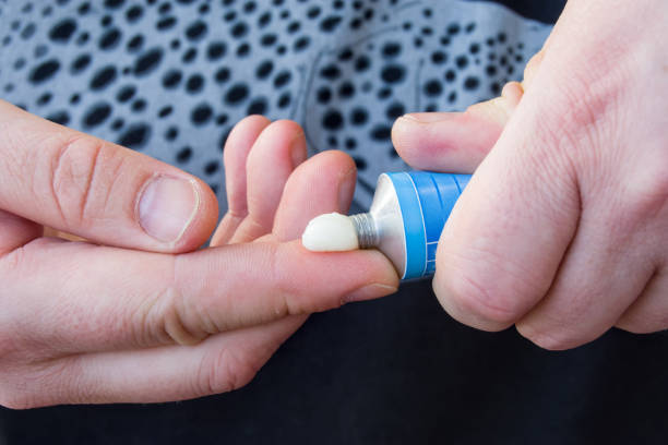 Patient squeezes out of aluminum tubes ointment with medicinal substance on finger. Photo of use of drug in form of ointments for application on skin and treating skin diseases, psoriasis, acne Patient squeezes out of aluminum tubes ointment with medicinal substance on finger. Photo of use of drug in form of ointments for application on skin and treating skin diseases, psoriasis, acne ointment photos stock pictures, royalty-free photos & images