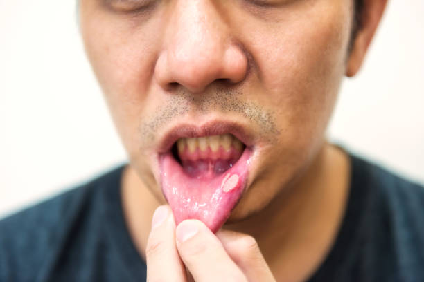 istock Pained aphtha ulcer mouth from accident 1157736364