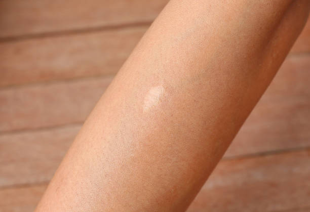 istock A scar on woman hand. 1157898188