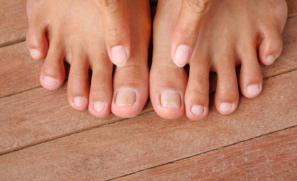 istock Point to Damaged toenail, broken nail 1157899147