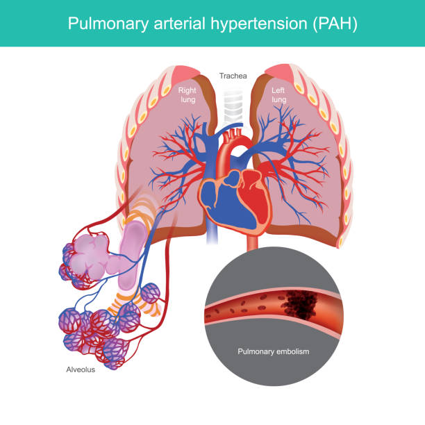 Hipertension Arterial - Banco de fotos e imágenes de stock - iStock