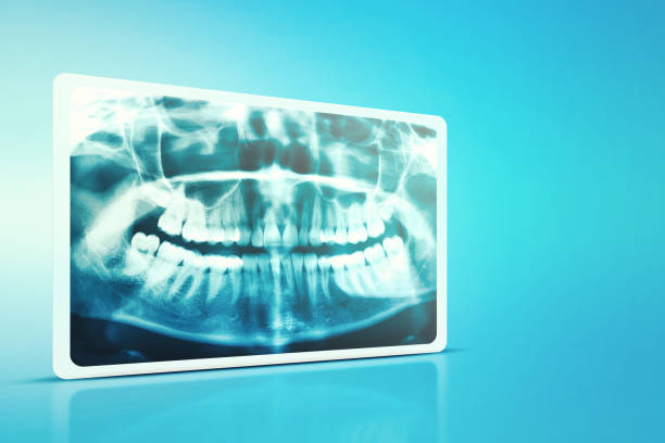 Woman x-ray of the teeth wisdom teeth horizontal pozition problem dentistry medicine. Panoramic image of teeth Panoramic image of teeth. Woman x-ray of the teeth wisdom teeth horizontal pozition problem dentistry medicine. teeth photos stock pictures, royalty-free photos & images