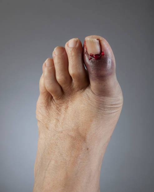 Broken left toe stock photo