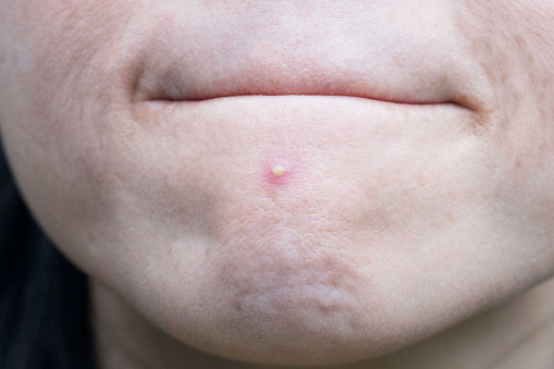 Acne pimple on nose in Asian woman skin face close up.