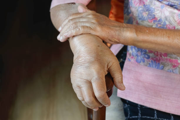 istock Elderly swollen hand or edema hand 1158240251