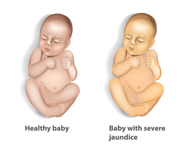 illustrations, cliparts, dessins animés et icônes de étendue de jaunisse (icterus) avec bébé - yellowing